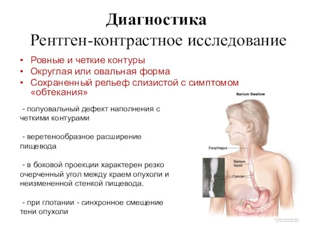 Диагностика Рентген-контрастное исследование Ровные и четкие контуры Округлая или овальная