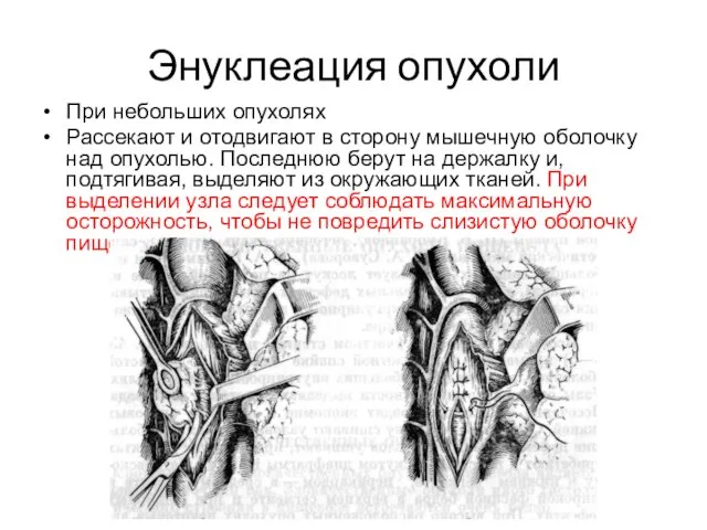 Энуклеация опухоли При небольших опухолях Рассекают и отодвигают в сторону