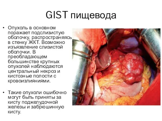 GIST пищевода Опухоль в основном поражает подслизистую оболочку, распространяясь в