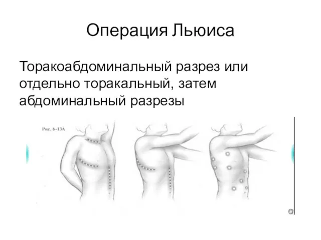 Операция Льюиса Торакоабдоминальный разрез или отдельно торакальный, затем абдоминальный разрезы