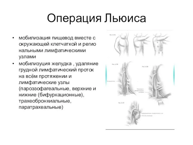 Операция Льюиса мобилизация пищевод вместе с окружающей клетчаткой и регио­нальными