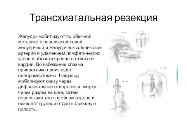 Трансхиатальная резекция Желудок мобилизуют по обычной методике с перевязкой ле­вой