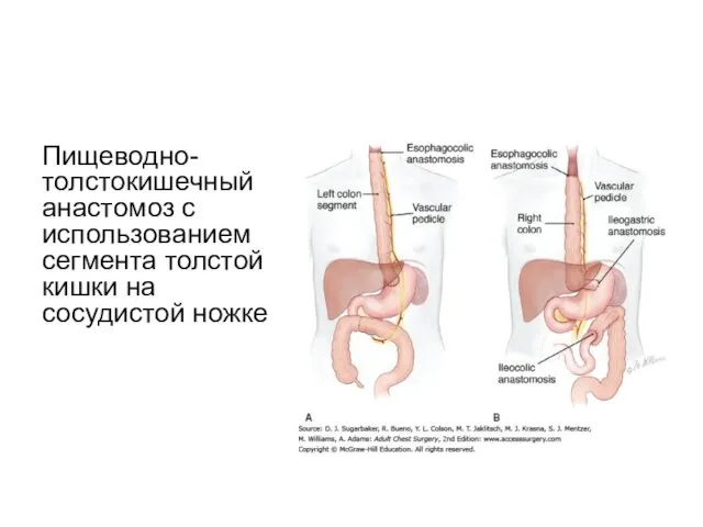 Пищеводно-толстокишечный анастомоз с использованием сегмента толстой кишки на сосудистой ножке