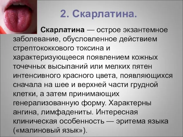 2. Скарлатина. Скарлатина — острое экзантемное заболевание, обусловленное действием стрептококкового