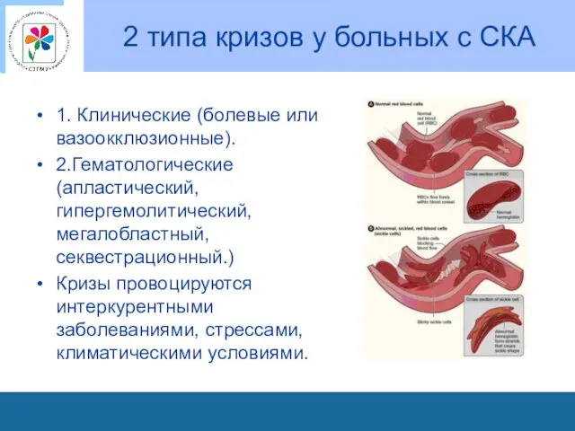 2 типа кризов у больных с СКА 1. Клинические (болевые