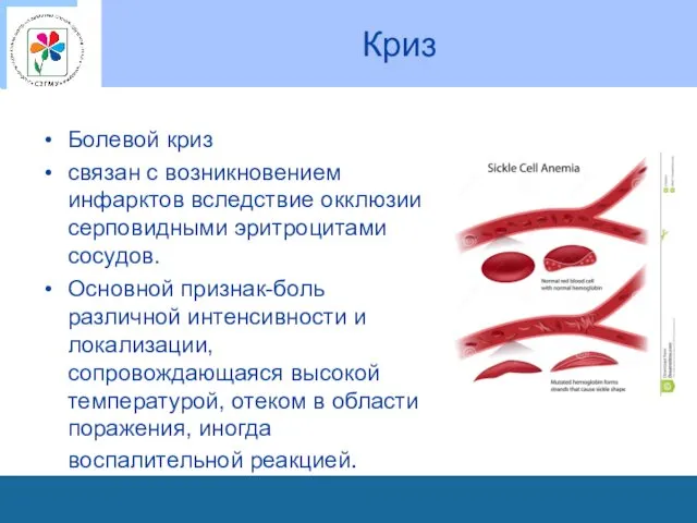 Криз Болевой криз связан с возникновением инфарктов вследствие окклюзии серповидными