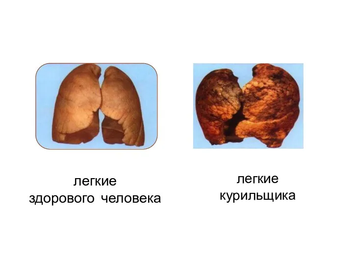 легкие здорового человека легкие курильщика