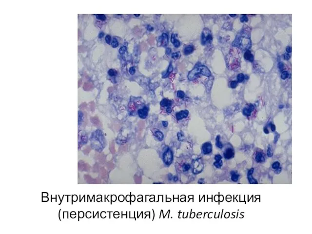 Внутримакрофагальная инфекция (персистенция) M. tuberculosis