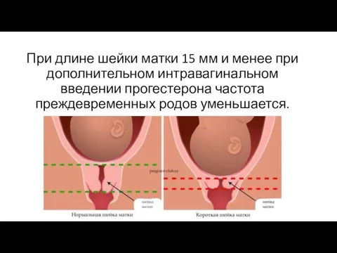 При длине шейки матки 15 мм и менее при дополнительном интравагинальном введении прогестерона