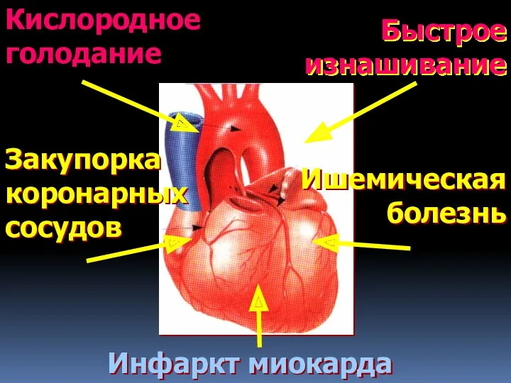 Быстрое изнашивание Закупорка коронарных сосудов Инфаркт миокарда Ишемическая болезнь Кислородное голодание