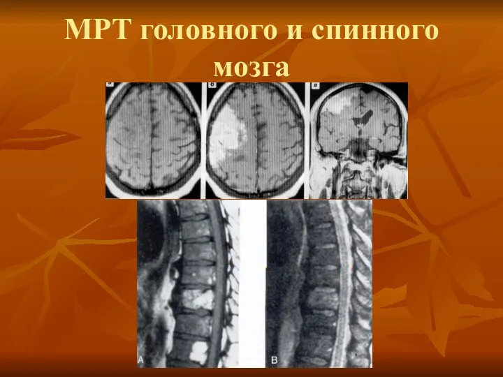 МРТ головного и спинного мозга