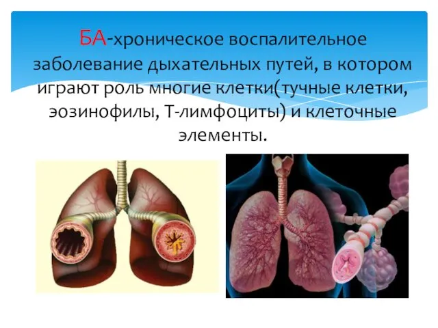 БА-хроническое воспалительное заболевание дыхательных путей, в котором играют роль многие