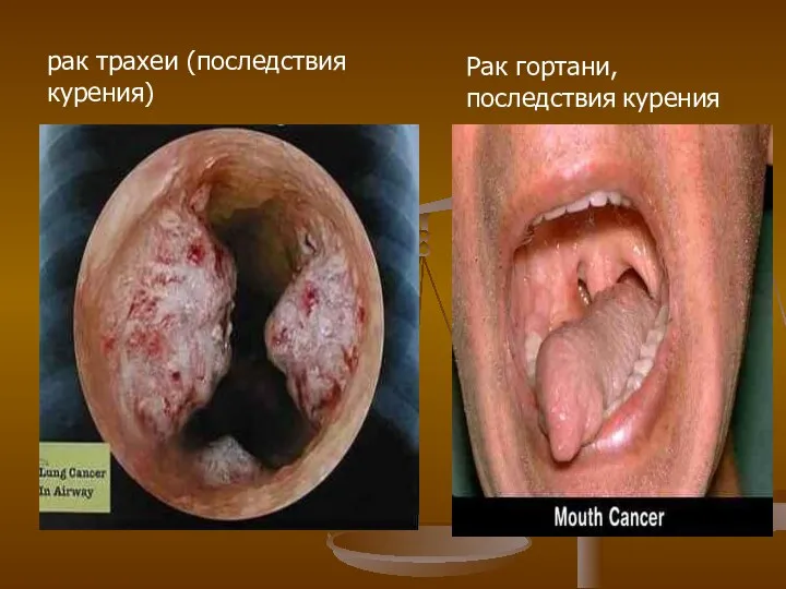 рак трахеи (последствия курения) Рак гортани, последствия курения