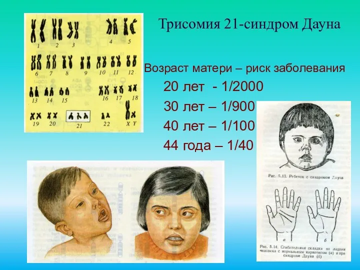 Трисомия 21-синдром Дауна Возраст матери – риск заболевания 20 лет