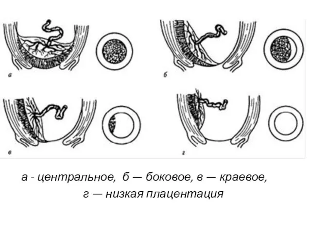 а - центральное, б — боковое, в — краевое, г — низкая плацентация