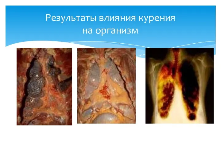 Результаты влияния курения на организм
