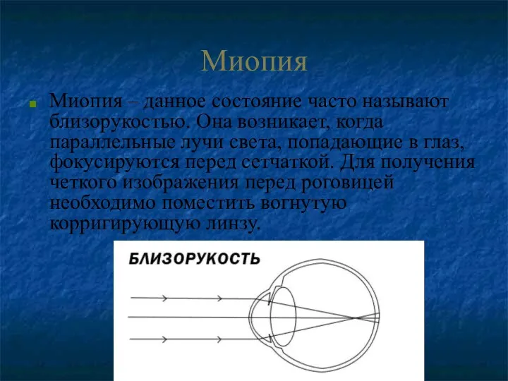 Миопия Миопия – данное состояние часто называют близорукостью. Она возникает, когда параллельные лучи