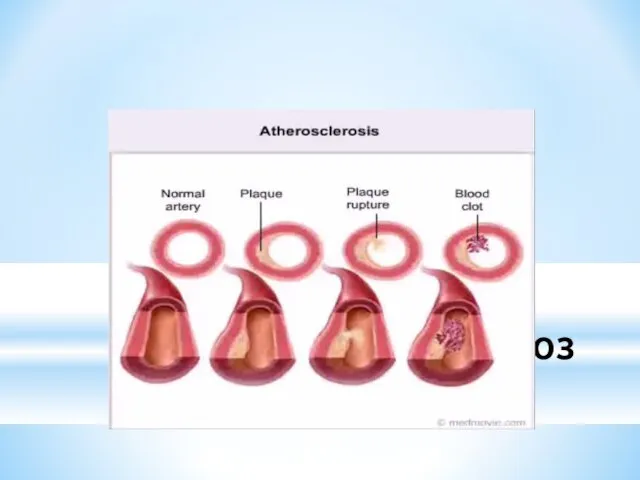 Атеросклероз