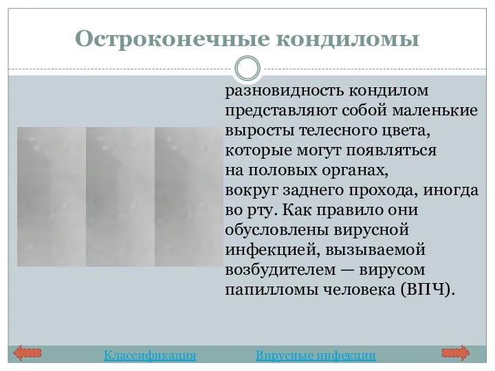 Остроконечные кондиломы разновидность кондилом представляют собой маленькие выросты телесного цвета,