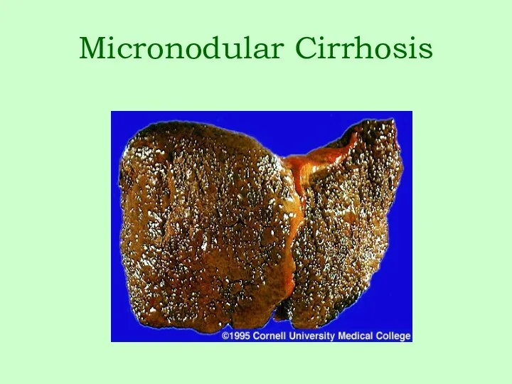 Micronodular Cirrhosis