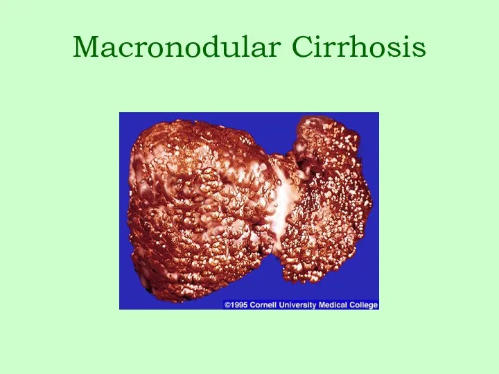 Macronodular Cirrhosis