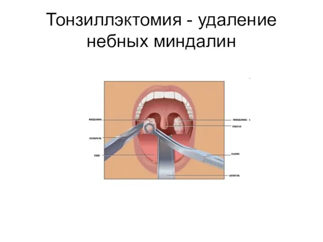 Тонзиллэктомия - удаление небных миндалин