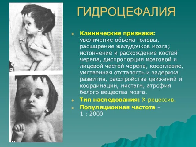 ГИДРОЦЕФАЛИЯ Клинические признаки: увеличение объема головы, расширение желудочков мозга; истончение