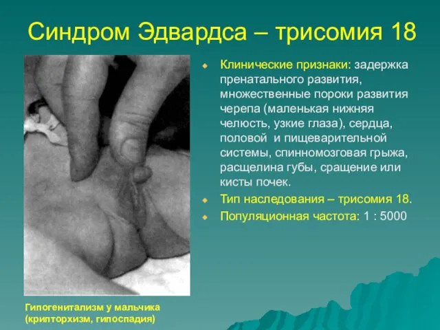 Синдром Эдвардса – трисомия 18 Клинические признаки: задержка пренатального развития,