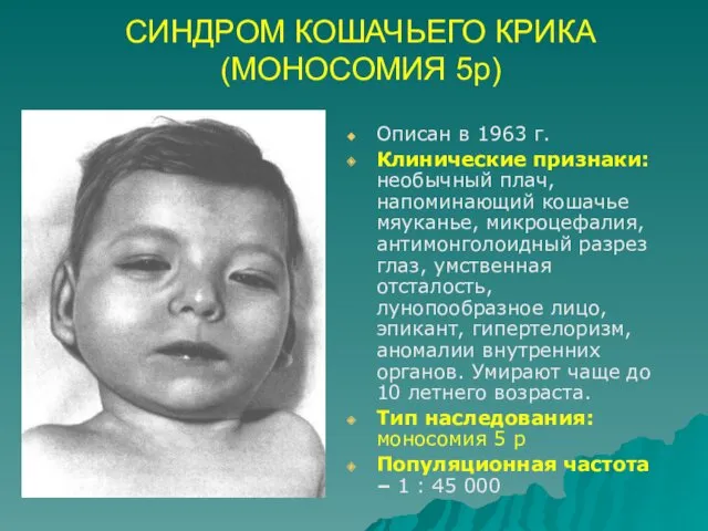 СИНДРОМ КОШАЧЬЕГО КРИКА (МОНОСОМИЯ 5р) Описан в 1963 г. Клинические