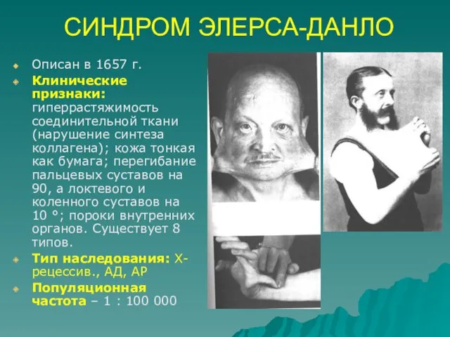 СИНДРОМ ЭЛЕРСА-ДАНЛО Описан в 1657 г. Клинические признаки: гиперрастяжимость соединительной