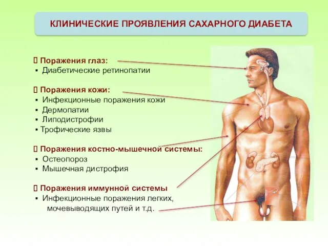 КЛИНИЧЕСКИЕ ПРОЯВЛЕНИЯ САХАРНОГО ДИАБЕТА Поражения глаз: Диабетические ретинопатии Поражения кожи: