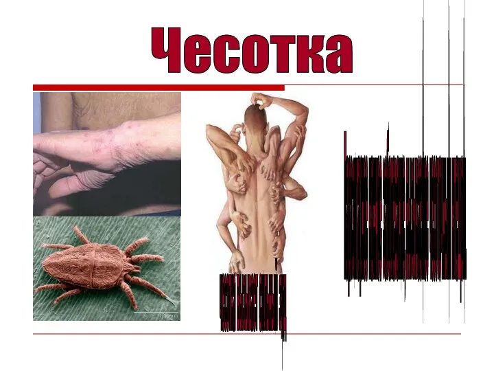 Чесотка чесотка вызывает сильный зуд Паразитарное кожное заболевание, вызываемое чесоточным клещом.