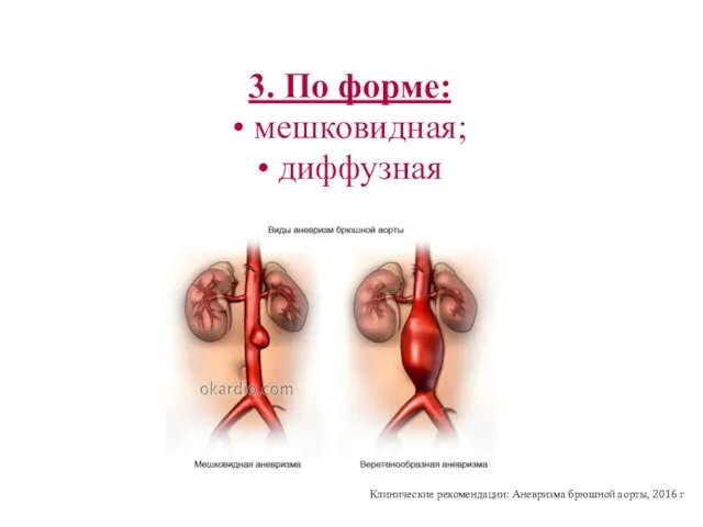 3. По форме: • мешковидная; • диффузная Клинические рекомендации: Аневризма брюшной аорты, 2016 г