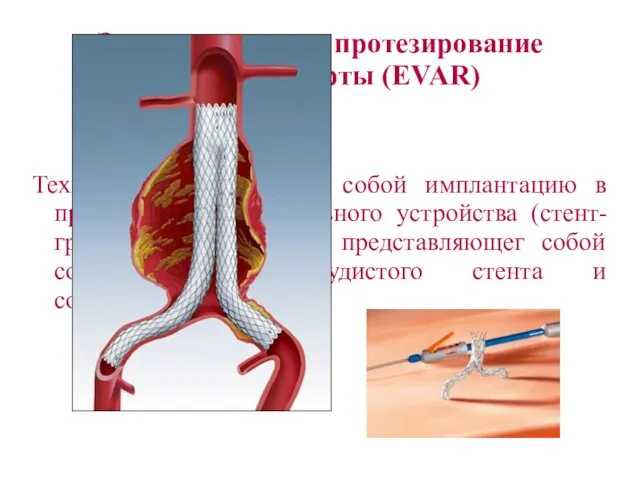 Эндоваскулярное протезирование брюшной аорты (EVAR) Технически представляет собой имплантацию в