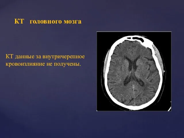 КТ головного мозга КТ данные за внутричерепное кровоизлияние не получены.