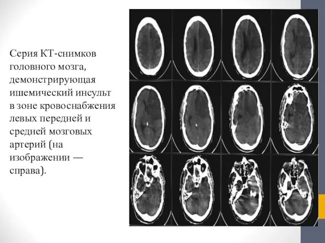 Серия КТ-снимков головного мозга, демонстрирующая ишемический инсульт в зоне кровоснабжения