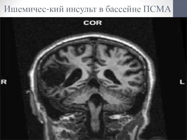 Ишемичес-кий инсульт в бассейне ПСМА