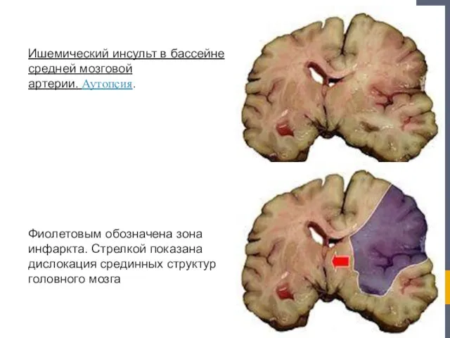 Ишемический инсульт в бассейне средней мозговой артерии. Аутопсия. Фиолетовым обозначена