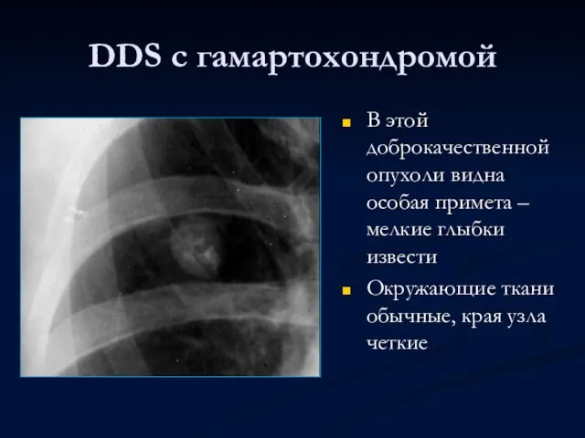 DDS с гамартохондромой В этой доброкачественной опухоли видна особая примета