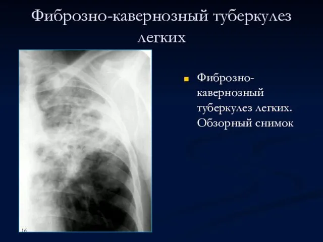 Фиброзно-кавернозный туберкулез легких Фиброзно-кавернозный туберкулез легких. Обзорный снимок