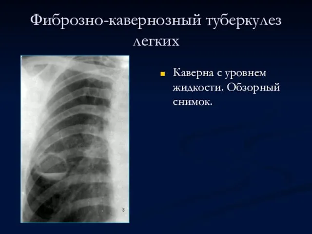 Фиброзно-кавернозный туберкулез легких Каверна с уровнем жидкости. Обзорный снимок.