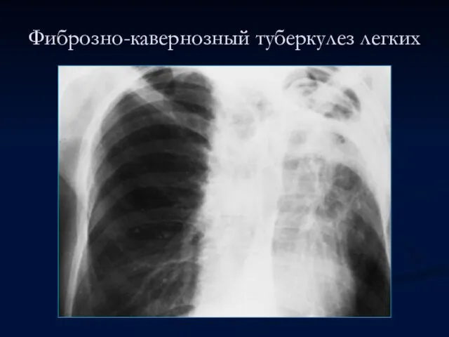 Фиброзно-кавернозный туберкулез легких