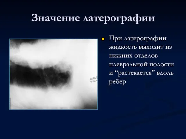 Значение латерографии При латерографии жидкость выходит из нижних отделов плевральной полости и “растекается” вдоль ребер