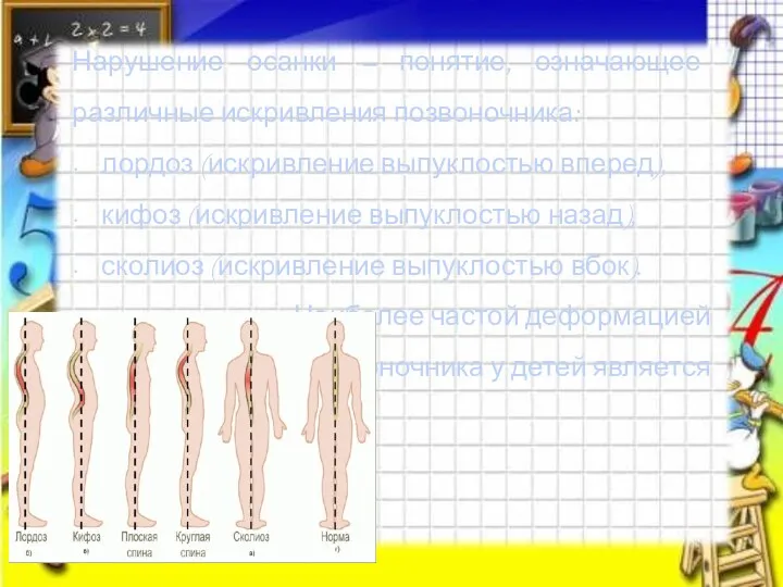 Нарушение осанки – понятие, означающее различные искривления позвоночника: лордоз (искривление