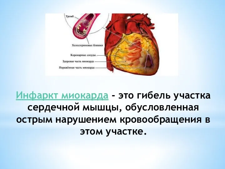 Инфаркт миокарда - это гибель участка сердечной мышцы, обусловленная острым нарушением кровообращения в этом участке.