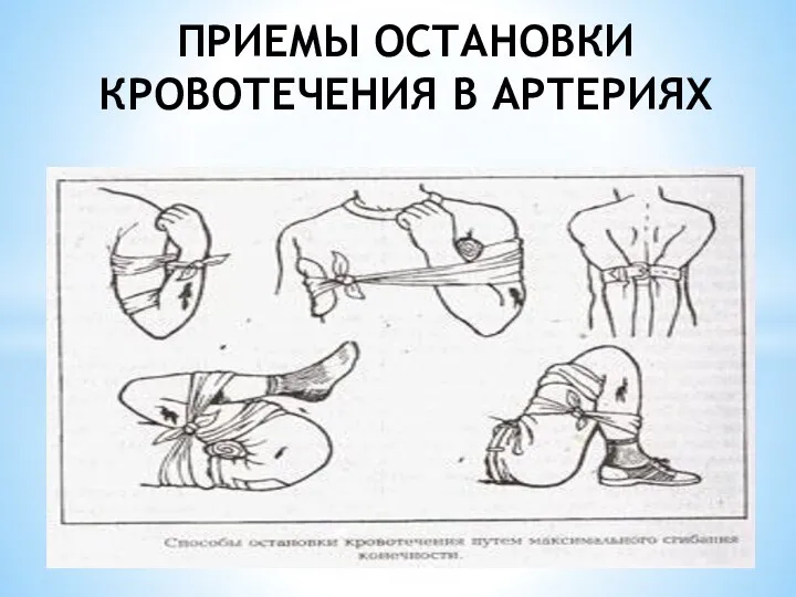 ПРИЕМЫ ОСТАНОВКИ КРОВОТЕЧЕНИЯ В АРТЕРИЯХ