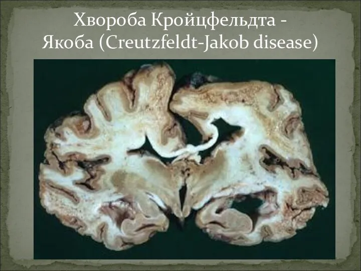 Хвороба Кройцфельдта - Якоба (Creutzfeldt-Jakob disease)