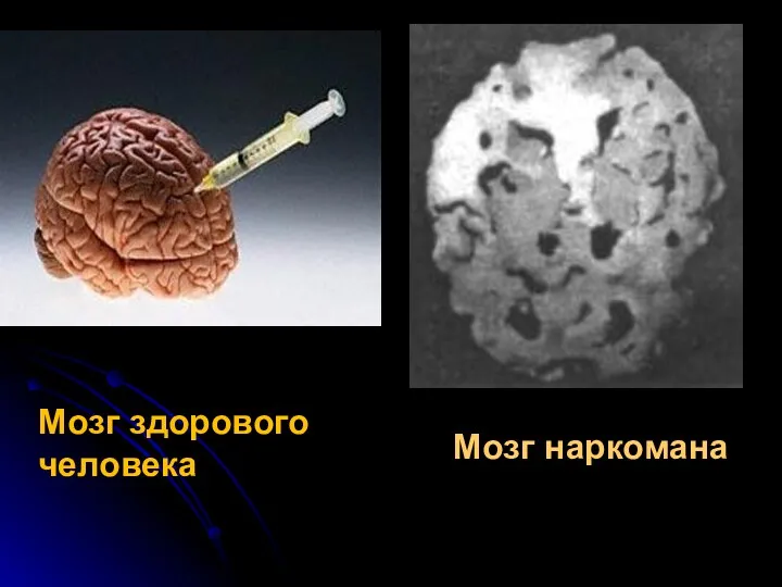 Мозг наркомана Мозг здорового человека