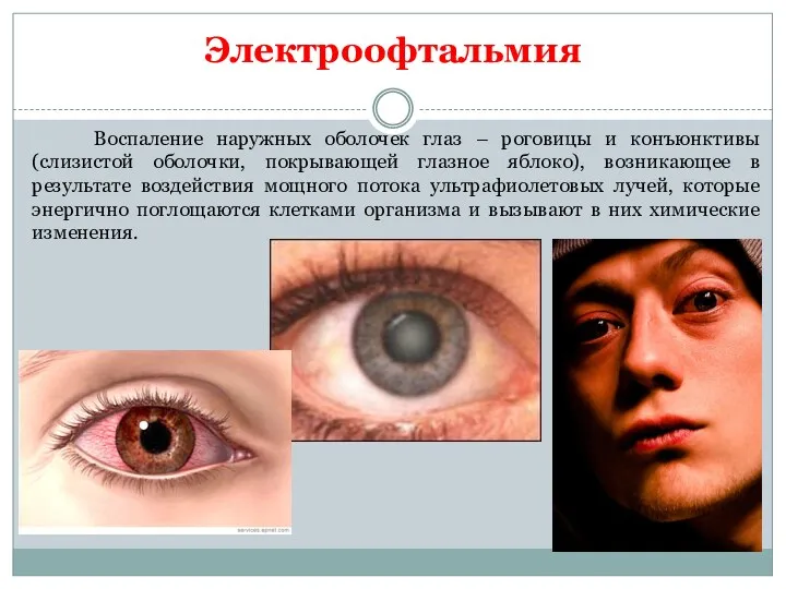 Электроофтальмия Воспаление наружных оболочек глаз – роговицы и конъюнктивы (слизистой