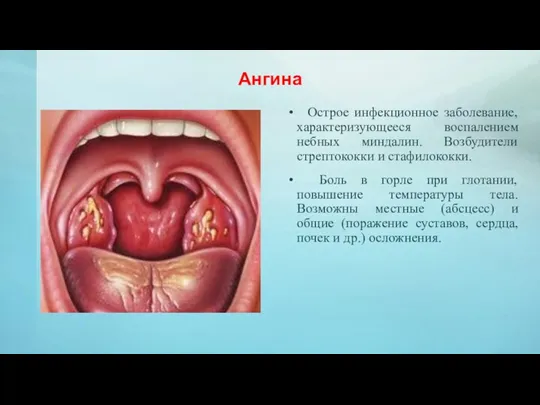 Ангина Острое инфекционное заболевание, характеризующееся воспалением небных миндалин. Возбудители стрептококки